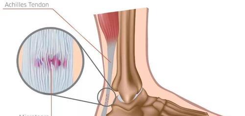 如何应对跟腱腱围炎的跑步技巧（跟腱腱围炎患者必看）